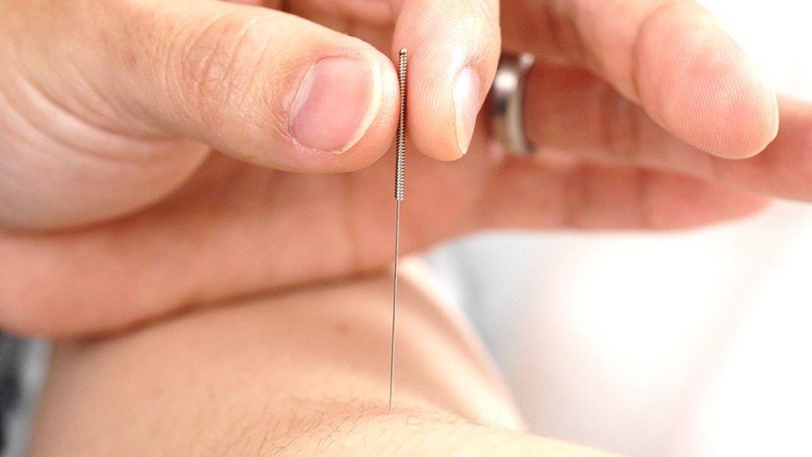 Acupuncture Doctor in Madurai