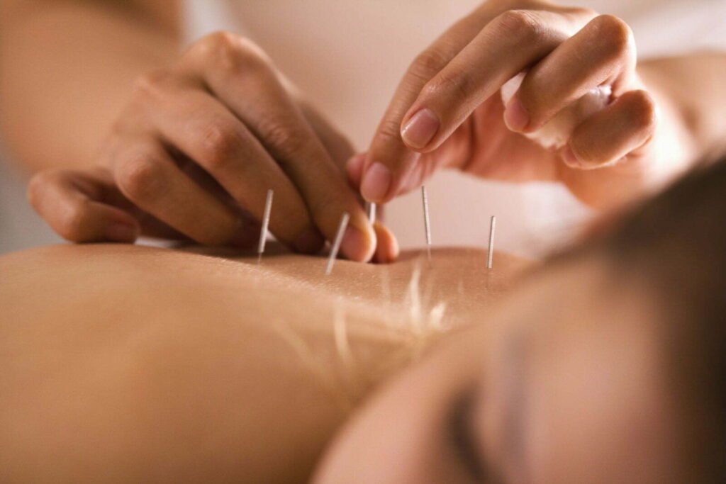 Acupuncturist in Madurai